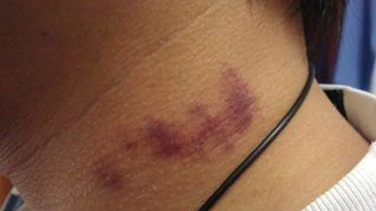 רץ ברשת – צעיר בן 17 נפטר לאחר שקיבל "היקי" קטלני בצוואר | חדשות 13