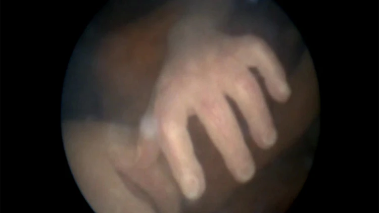 לראשונה בישראל: ניתוח נדיר בעובר בתוך הרחם | חדשות 13