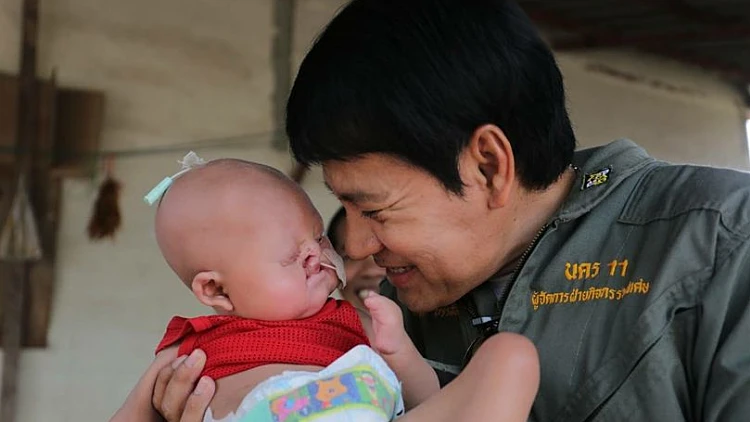 שובר לב: נולדה עם תסמונת "בתולת ים" | חדשות 13