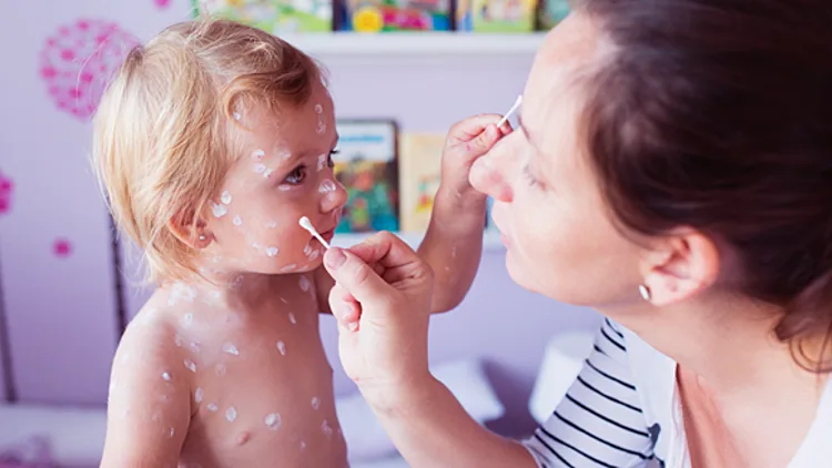 מתי יפסק הטרנד המסוכן של הדבקה באבעבועות רוח?