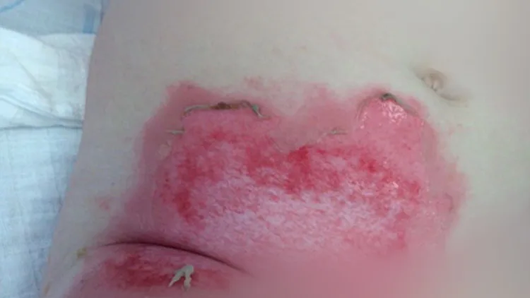 הפעוטה פונתה בשל כוויה קשה