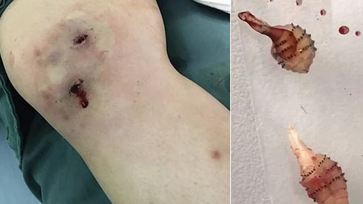 מכירים זבובים? זה מה שקרה לאישה שננשכה ע"י אחד | חדשות 13