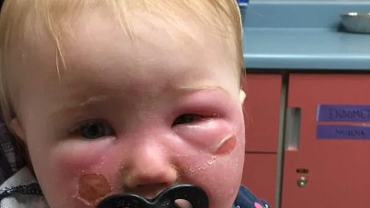 פניה של תינוקת נכוו בעקבות שימוש בקרם הגנה