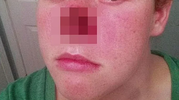 פצעון קטן על האף גרם לה לאבד חצי מפניה 