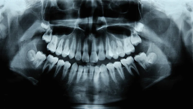 תצלום שיניים (אילוסטרציה)