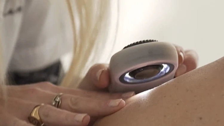 טיפול בנקודות חן