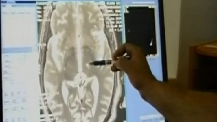 טיפול חדשני לחולי פרקינסון