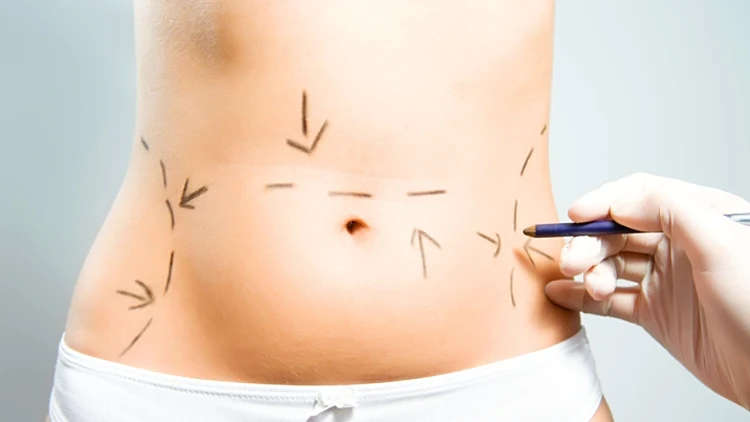 סימנים על הבטן