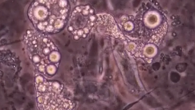 חיים בריא: יום המודעות למחלות נדירות