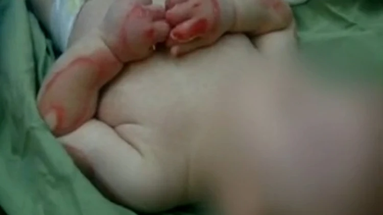 תינוקת נכוותה בפעוטון