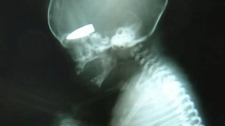 עובר שנטען כי נורה על ידי צלפים בסוריה