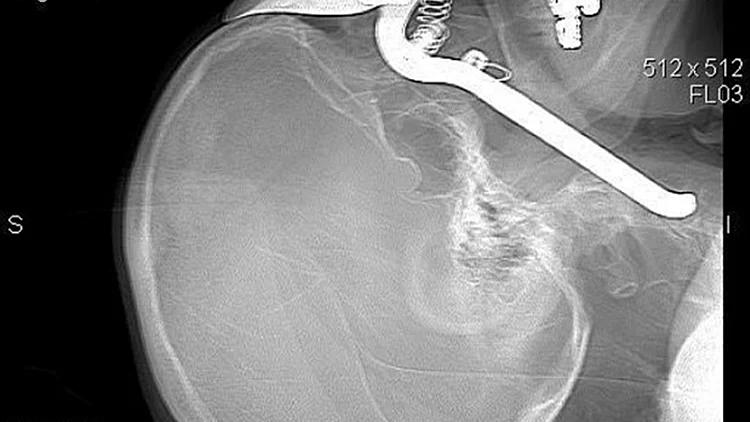 בדיקת CT של הגולגולת של איש מאריזונה בתאונת גינון