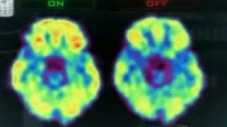מחקר חדש מוכיח: לשימוש בסלולר יש השפעה על המוח