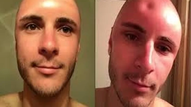 השמש גרמה לחור בראשו