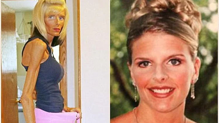 הדוגמנית בת ה-34 עם תסמונת SMA מתכוננת למוות