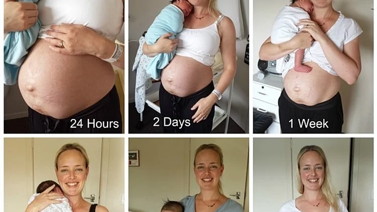 בטן אחרי לידה