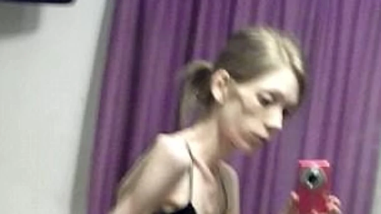 מאנורקסיה קשה למפתחת גוף