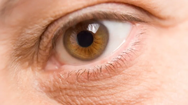 עיניים מקומטות