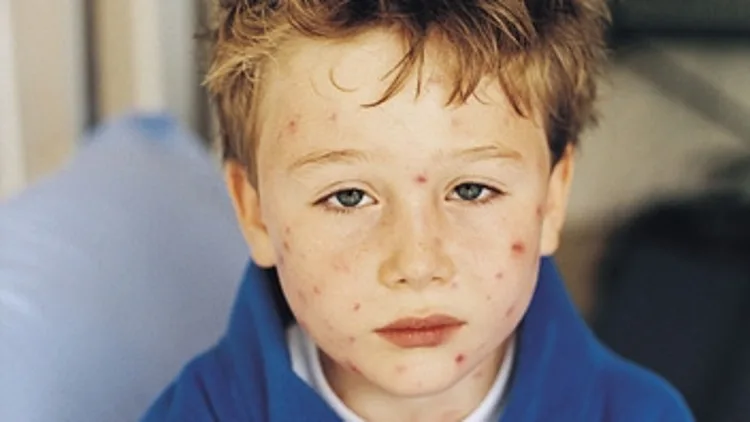 ילדה חולה באבעבועות רוח