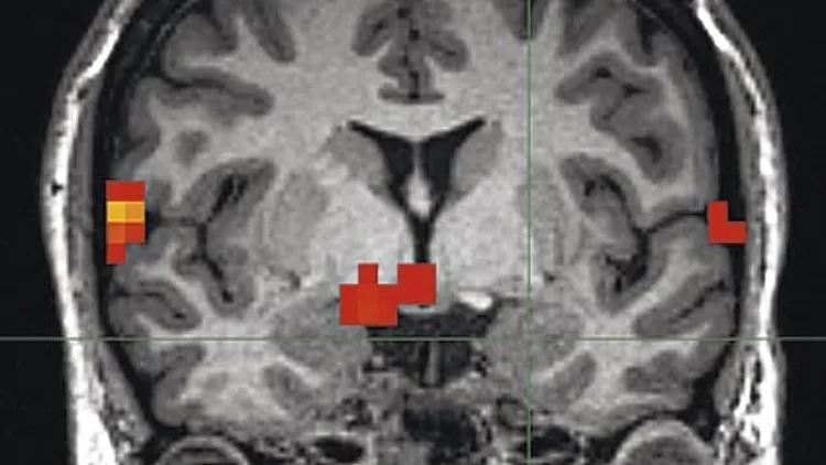 סריקת fMRI  של מוח אנושי