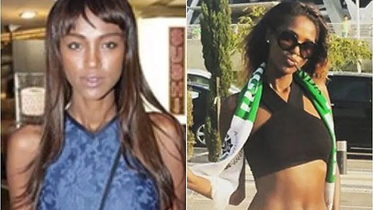 חושפת את עודפי העור לאחר הדיאטה