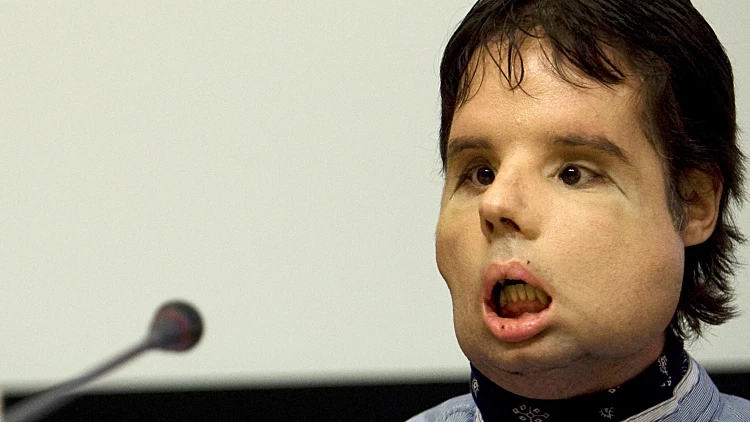 אוסקר שעבר השתלת פנים במסיבת עיתונאים בברצלונה