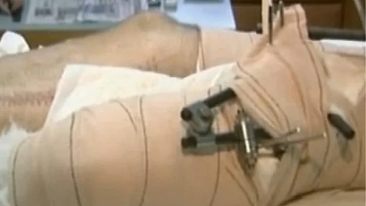 השתלת רגליים