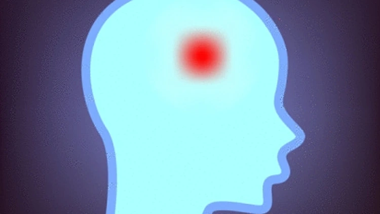 איור של שבץ מוחי