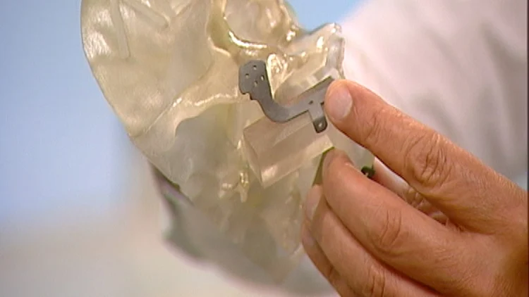 שחזור פה ולסת במדפסת תלת מימד