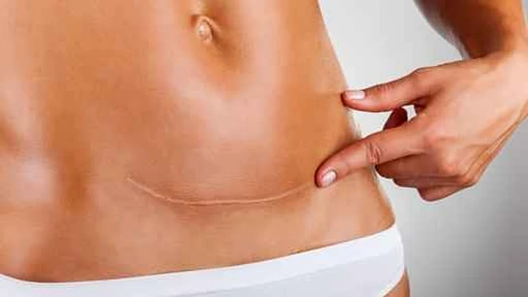 חיים בריא: טיפול רפואי בצלקות