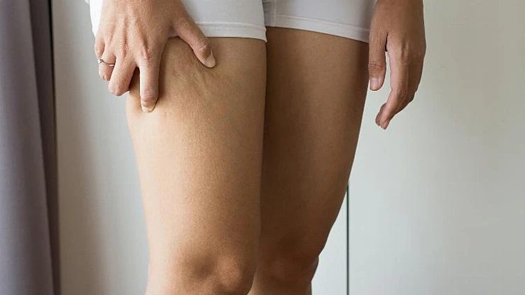 צלוליט ברגליים