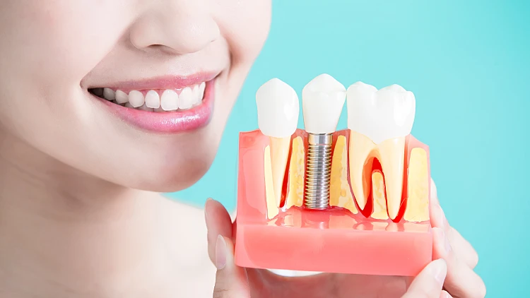 שתלים דנטליים