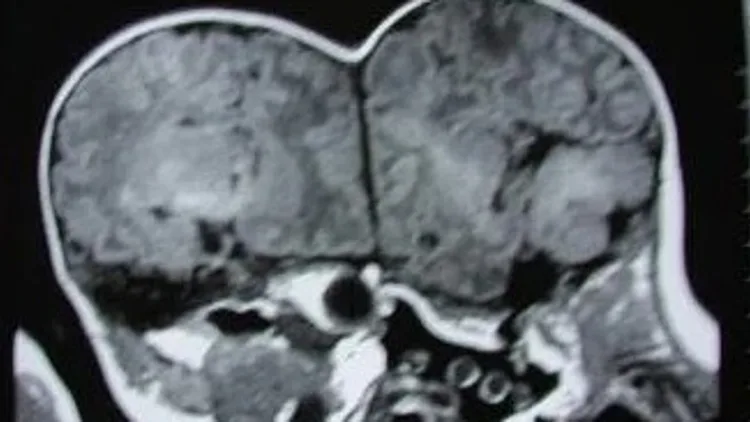 לראשונה בישראל: נולדו תאומות סיאמיות מחוברות בראש