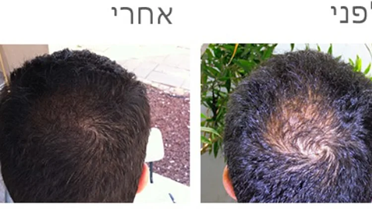 השתלות שיער בטורקיה? הרובוט מישראל עושה עבודה טובה יותר | רשת 13