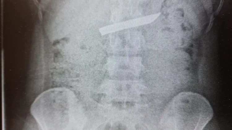 "מזל גדול": סכין באורך 9 ס"מ שנבלעה בטעות – הוצאה מקיבתה של בת 18 | חדשות 13