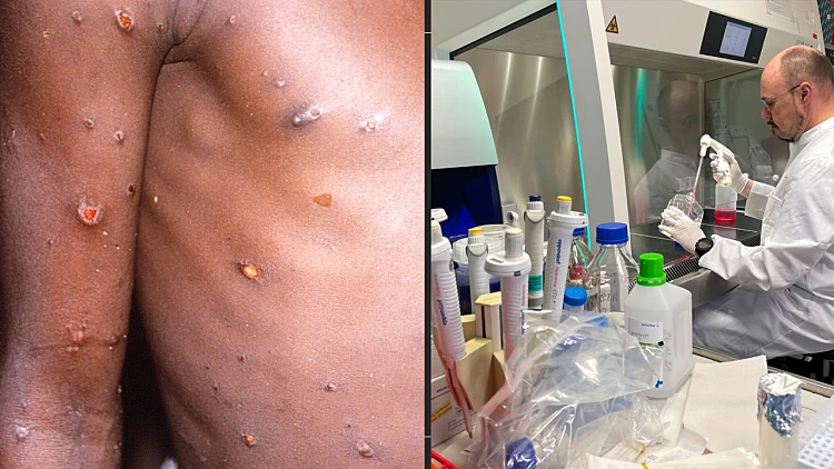 אבעבועות הקוף