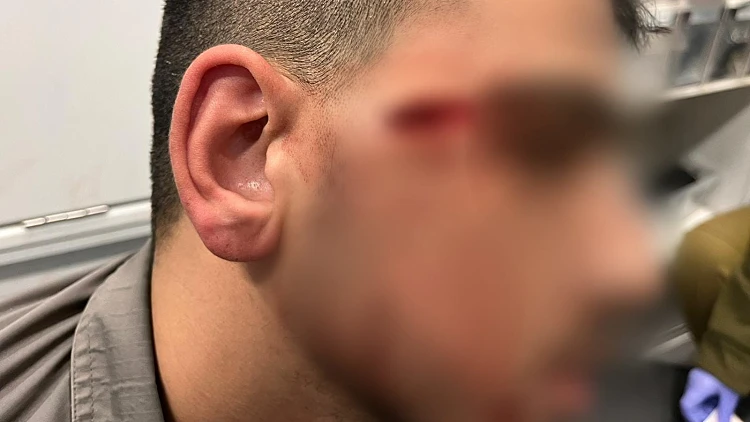 לוחם מג"ב שנפצע בפיגוע בחווארה