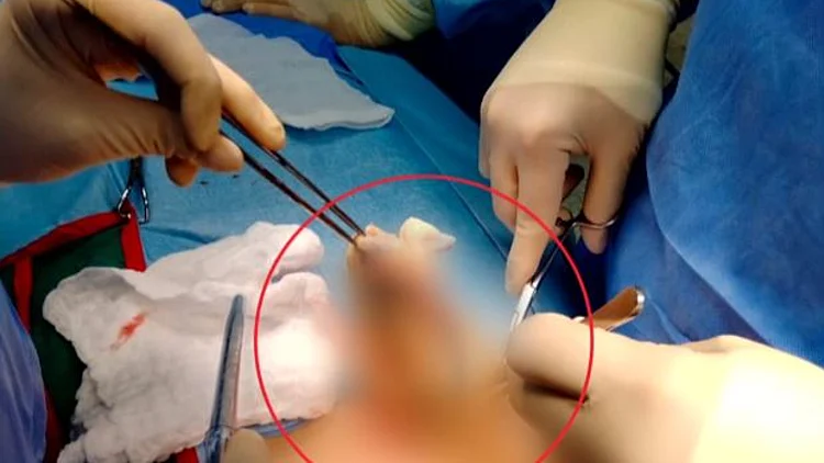 "סיוט שאני לא מאחלת לאף אחת": מגבת נשכחה בבטנה של יולדת