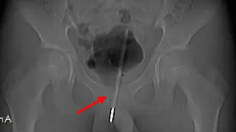 צילומי הרנטנגן של המדחום באיבר המין