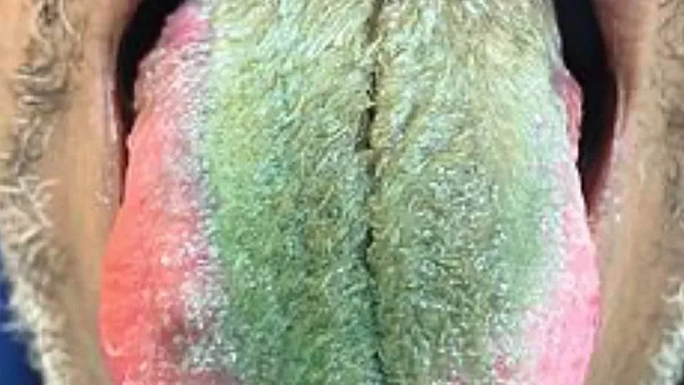 הלשון שנצבעה בירוק