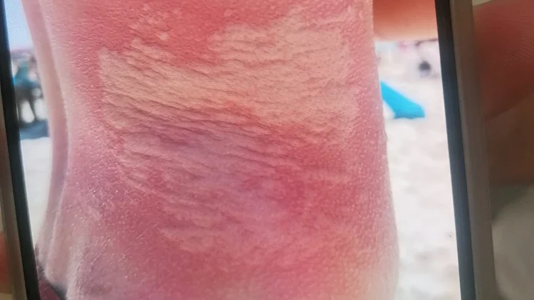 הצעיר שנפגע ממדוזה