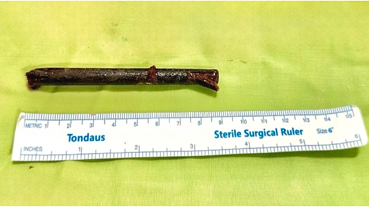 חי במשך 3 שבועות עם צ'ופסטיק בעין ולא הבין למה כואב לו