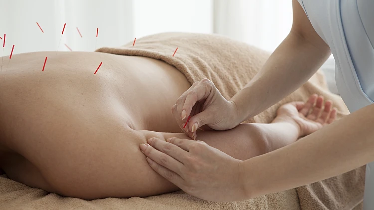 Patients,undergoing,acupuncture,on,the,body,in,the,salon