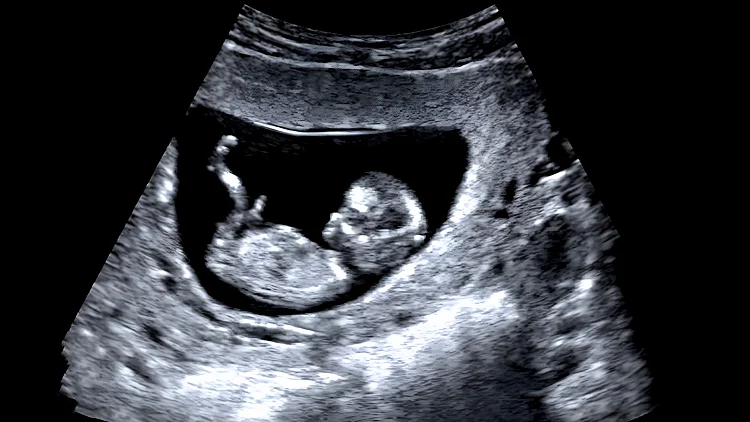 The,picture,shows,an,ultrasound,scan,of,a,foetus,in