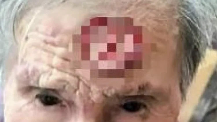 קשישה הסירה בעצמה קרן שצמחה לה על המצח