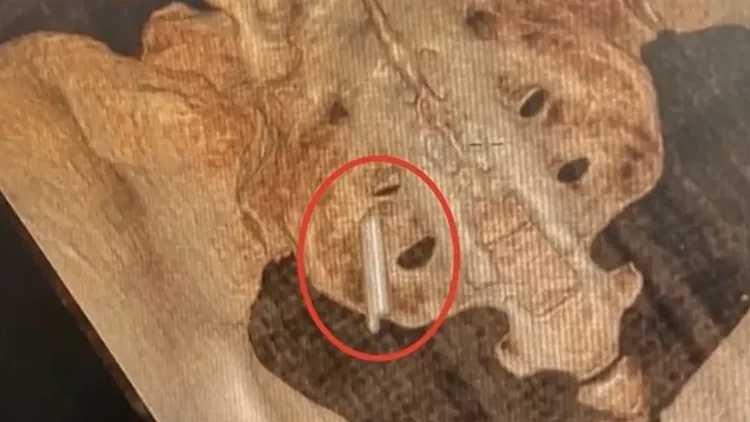 שבר המדחום שהוסר מעכוזה של המטופלת