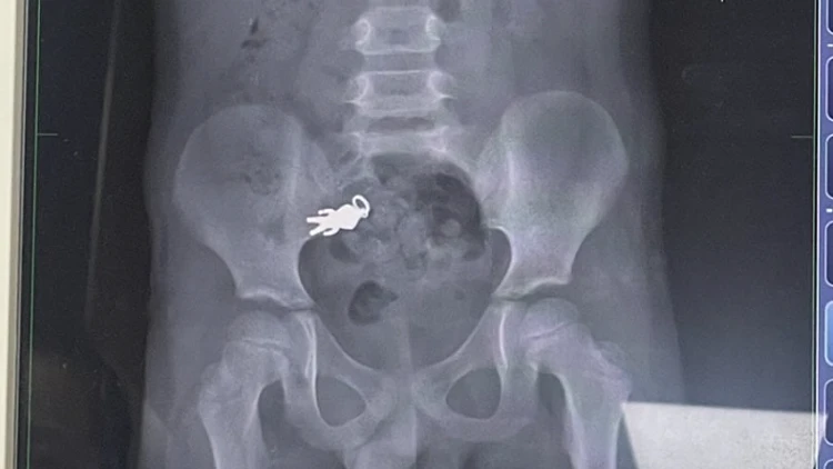 צילום רנטגן