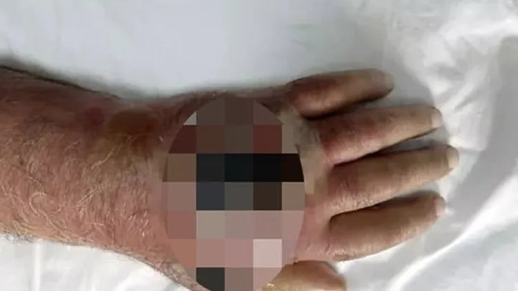 הזרוע הפצועה