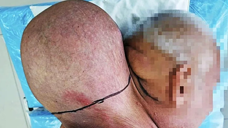 הגידול שצמח על צווארו של המטופל