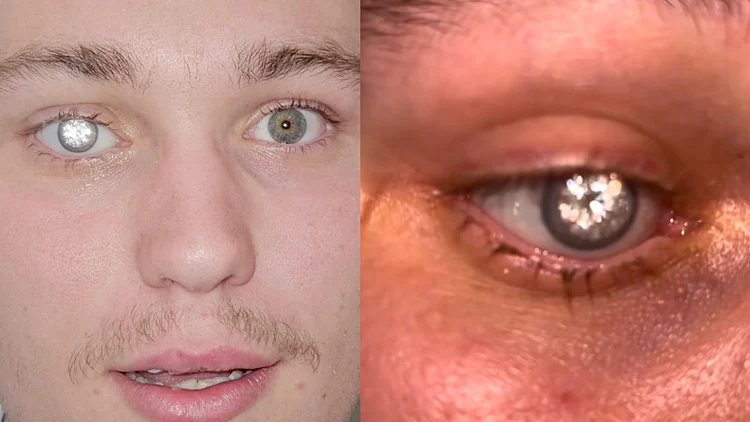 בעל חנות תכשיטים הטמיע יהלום בעין התותבת שלו